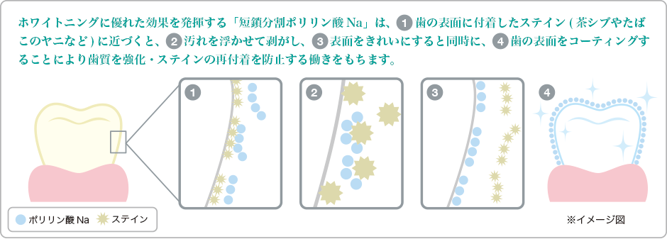 ポリリンホワイトニング